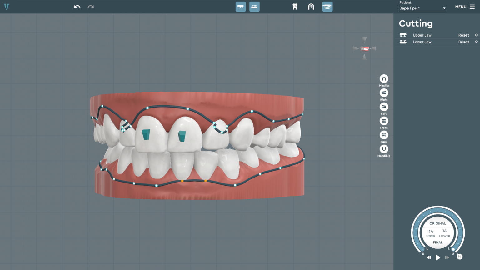 The Disruptive Power of AI in Orthodontics How SoftSmile is