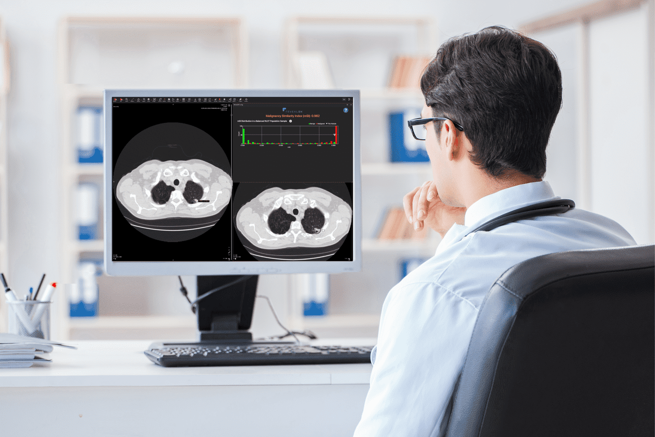 lung cancer